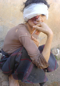 حالة مرضية غريبة: جزائرية مصابة بورم ينهش وجهها! صورة رقم 1